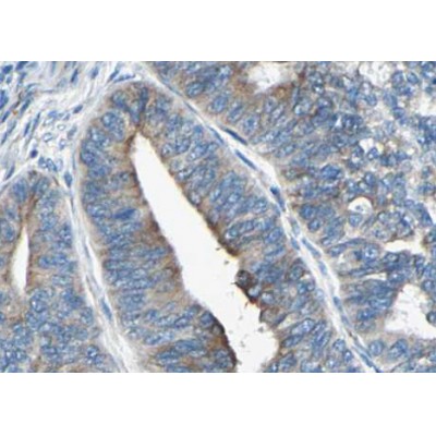 Phospho-Synaptotagmin 1/2 (Thr202) Antibody - AF3224 at 1/100 staining human Thyroid cancer tissue sections by IHC-P.