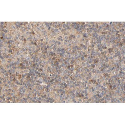 Phospho-p70 S6 Kinase (Ser424)[Ser447] Antibody - AF3230 at 1/100 staining human Lymphoma tissue sections by IHC-P.