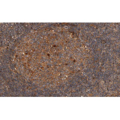 Phospho-p70 S6 Kinase (Thr421)[Thr444] Antibody - AF3231 at 1/100 staining human Lymphoma tissue sections by IHC-P.