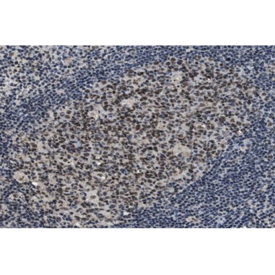 Phospho-GSK3 alpha (Ser21) Antibody - AF3336 at 1/100 staining human Lymphoma tissue sections by IHC-P.