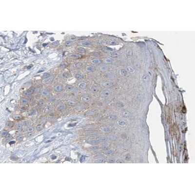 Phospho-VASP (Ser157) Antibody - AF3337 at 1/100 staining human Skin cancer tissue sections by IHC-P.