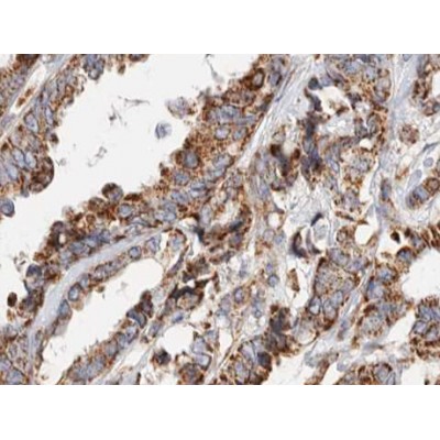 gamma Synuclein Antibody - AF0258 at 1/100 staining human breast carcinoma tissue sections by IHC-P.