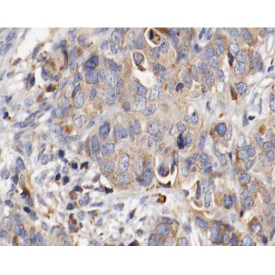 Fibrillin 1 Antibody - AF0429 at 1/100 staining human ovarian cancer tissue sections by IHC-P.