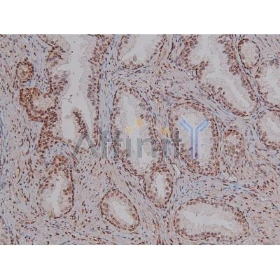 Phospho-CDK4 (Thr172) Antibody - AF8007 at 1/200 staining Human prostate cancer tissue sections by IHC-P.