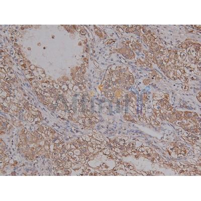 Phospho-PKA alpha  CAT (Ser339) Antibody - AF8017 at 1/200 staining Human liver cancer tissue sections by IHC-P.