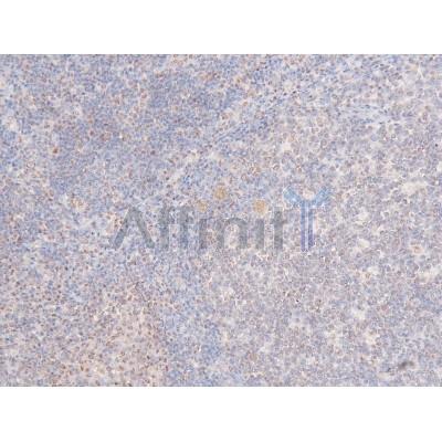 Phospho-CDK1/CDC2 (Thr161) Antibody - AF8137 at 1/200 staining Human lung cancer tissue sections by IHC-P.