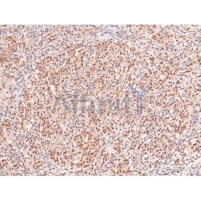 Phospho-IFNAR1 (Ser535) Antibody - AF8229 at 1/200 staining Human lung cancer tissue sections by IHC-P.