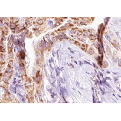 Phospho-BIK (Thr33) Antibody - AF3428 at 1/100 staining human Thyroid cancer tissue sections by IHC-P.