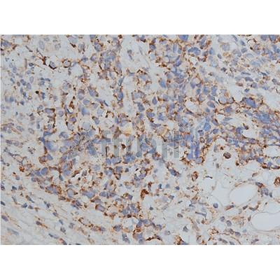 Collagen I Antibody - AF7001at 1/200 staining human breast cancer tissue sections by IHC-P.