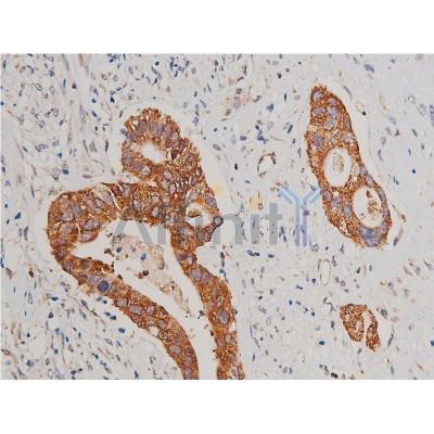 Cytochrome C Antibody - AF7004 at 1/200 staining human colon cancer tissue sections by IHC-P.