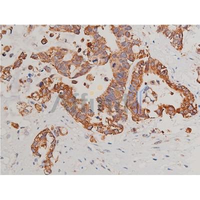 Cytochrome C Antibody - AF7004 at 1/200 staining human colon cancer tissue sections by IHC-P.
