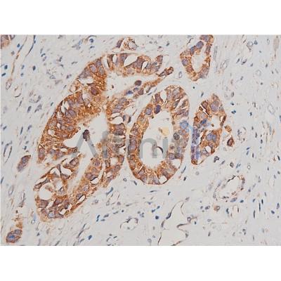Cytochrome C Antibody - AF7004 at 1/200 staining human colon cancer tissue sections by IHC-P.