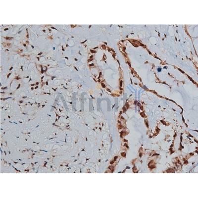TIMP4 Antibody - AF7009 at 1/50 staining human lung cancer tissue sections by IHC-P.
