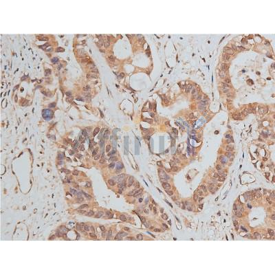 GAPDH Antibody - AF7021 at 1/50 staining human colon cancer tissue sections by IHC-P.