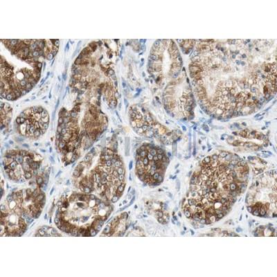 Phospho-DRP1 (Ser616) Antibody - AF8470 at 1/100 staining human Prostate carcinoma tissue sections by IHC-P.