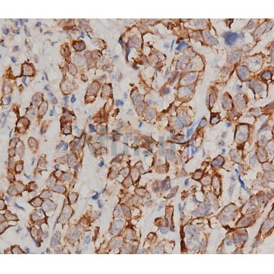 IL6 Antibody - DF6087 at 1/200 staining human breast cancer tissue sections by IHC-P.