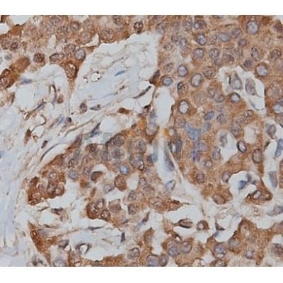 SLC25A13 Antibody - DF9303 at 1/200 staining human lymphoma tissue sections by IHC-P.