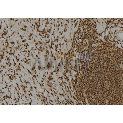 Claspin Antibody - DF7525 at 1/100 staining Human gastric tissue by IHC-P.