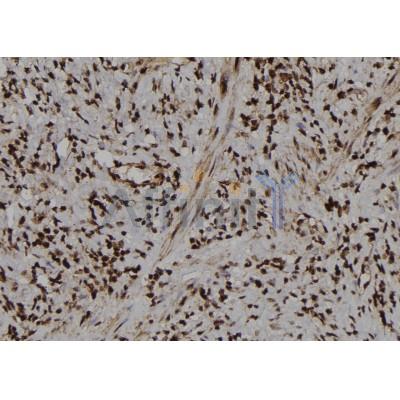 Phospho-PKM2 (Tyr370) Antibody - AF7229 at 1/100 staining human gastric cancer tissue sections by IHC-P.
