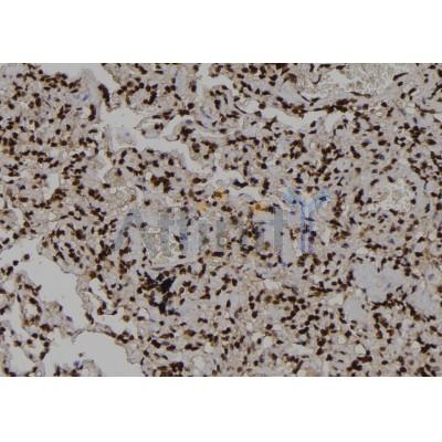 Phospho-PKM2 (Tyr370) Antibody - AF7229 at 1/100 staining human lung cancer tissue sections by IHC-P.
