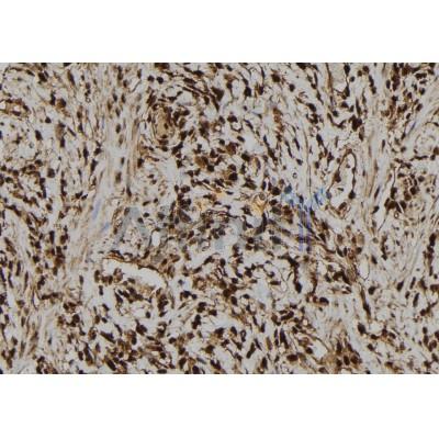 Phospho-4E-BP1 (Thr45) Antibody - AF7376 at 1/100 staining human gastric cancer tissue sections by IHC-P.