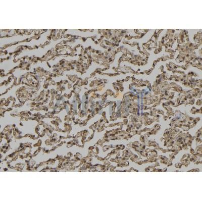 Phospho-TMEM173/STING (Ser366) Antibody - AF7416 at 1/100 staining human lung cancer tissue sections by IHC-P.