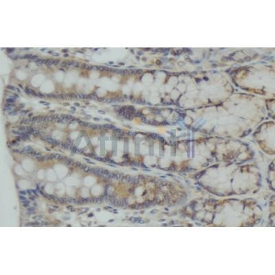 CEP55 Antibody - DF3918 at 1/100 staining human colon carcinoma tissue sections by IHC-P.