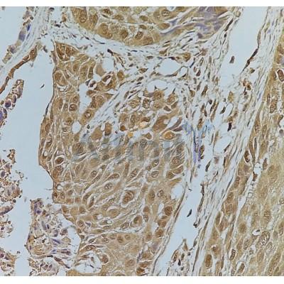 Phospho-FOXO1A (Ser319) Antibody - AF3418 at 1/100 staining Human  esophageal cancer tissue by IHC-P.