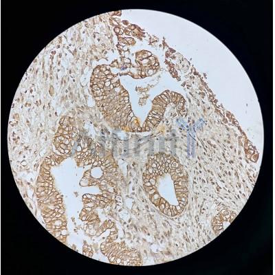 S100A10 Antibody - AF5180 at 1/100 staining human pancreas carcinoma tissue sections by IHC-P.