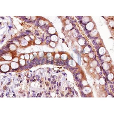 ADAMTS5 Antibody - DF13268 at 1/100 staining Human colon carcinoma tissue sections by IHC-P.