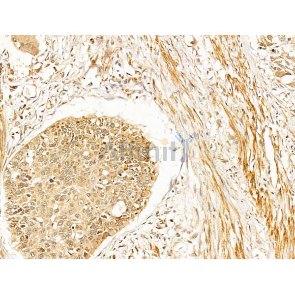 ERK1/2 Antibody - AF0155 at 1/100 staining Human esophageal cancer by IHC-P.