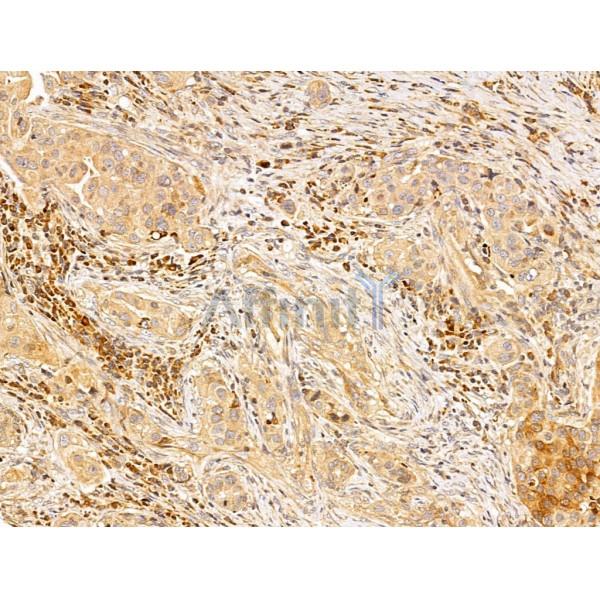 ERK1/2 Antibody - AF0155 at 1/100 staining Human mammary cancer by IHC-P.