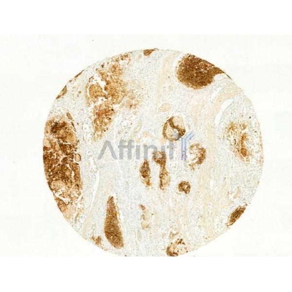 GLUT1 Antibody - AF0173 at 1/100 staining Human esophageal cancer by IHC-P.