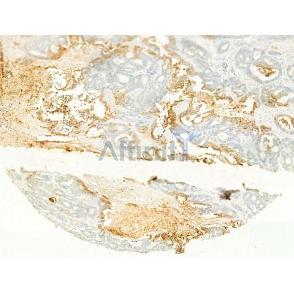 GLUT1 Antibody - AF0173 at 1/100 staining Human colorectal cancer by IHC-P.