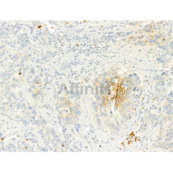 GLUT1 Antibody - AF0173 at 1/100 staining Human mammary cancer by IHC-P.