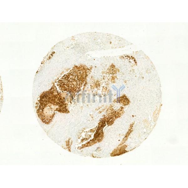 GLUT1 Antibody - AF0173 at 1/100 staining Human esophageal cancer by IHC-P.