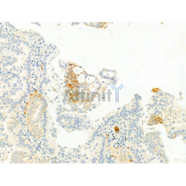 GLUT1 Antibody - AF0173 at 1/100 staining Human lung cancer by IHC-P.