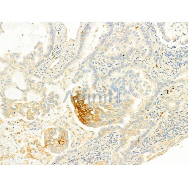 GLUT1 Antibody - AF0173 at 1/100 staining Human lung cancer by IHC-P.