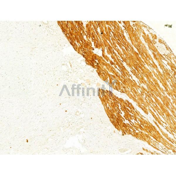 MMP2 Antibody - AF0577 at 1/100 staining Human pancreatic cancer by IHC-P.