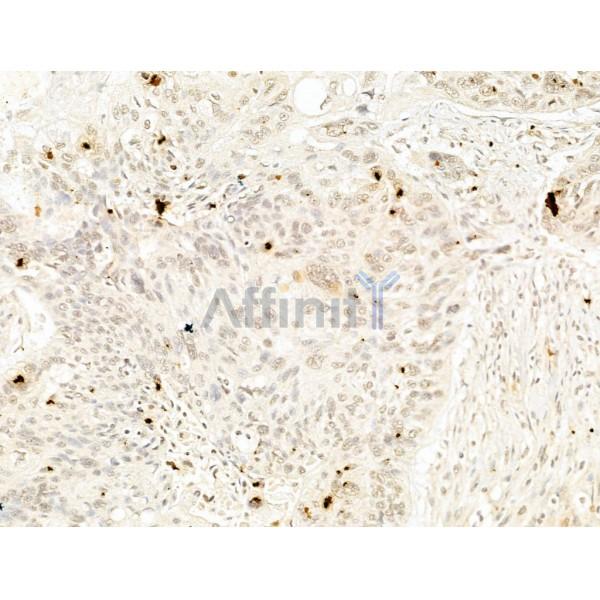 Phospho-IKK beta (Tyr188) Antibody - AF3009 at 1/100 staining Human lung cancer by IHC-P.