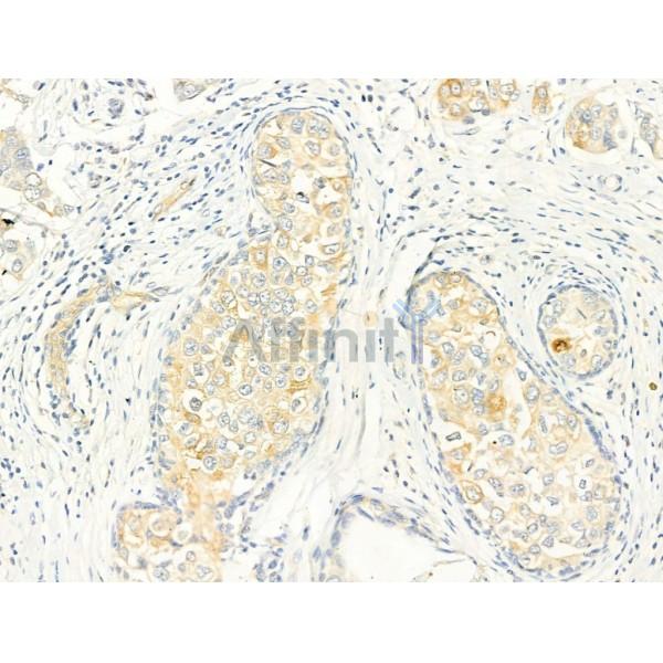 Phospho-ROCK2 (Tyr722) Antibody - AF3028 at 1/100 staining Human mammary cancer by IHC-P.