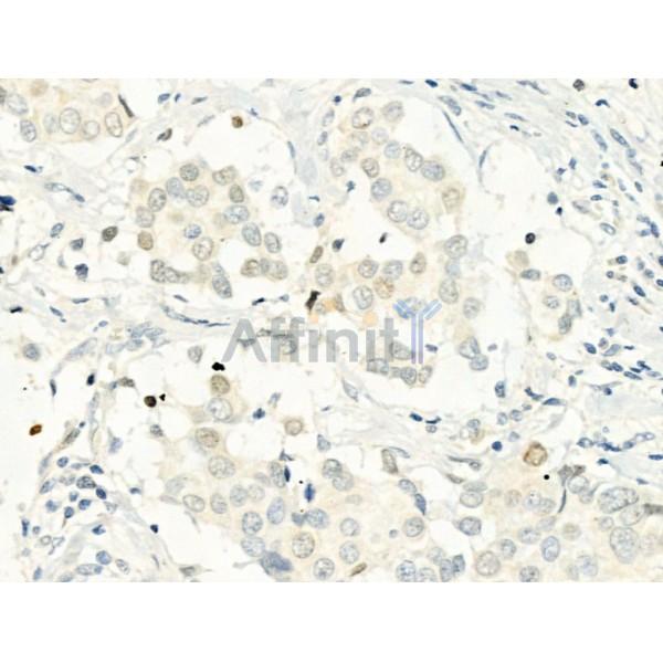 Phospho-Histone H2A.X (Ser139)[Ser140] Antibody - AF3187 at 1/100 staining Human mammary cancer by IHC-P.