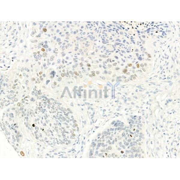 Phospho-Histone H2A.X (Ser139)[Ser140] Antibody - AF3187 at 1/100 staining Human lung cancer by IHC-P.