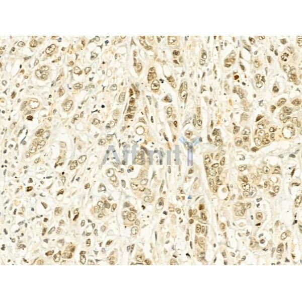Phospho-mTOR (Ser2448) Antibody - AF3308 at 1/100 staining Human gastric cancer by IHC-P.