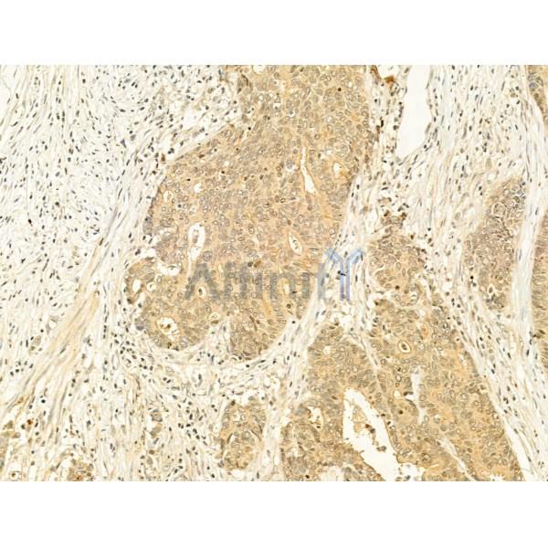 Phospho-mTOR (Ser2448) Antibody - AF3308 at 1/100 staining Human colorectal cancer by IHC-P.