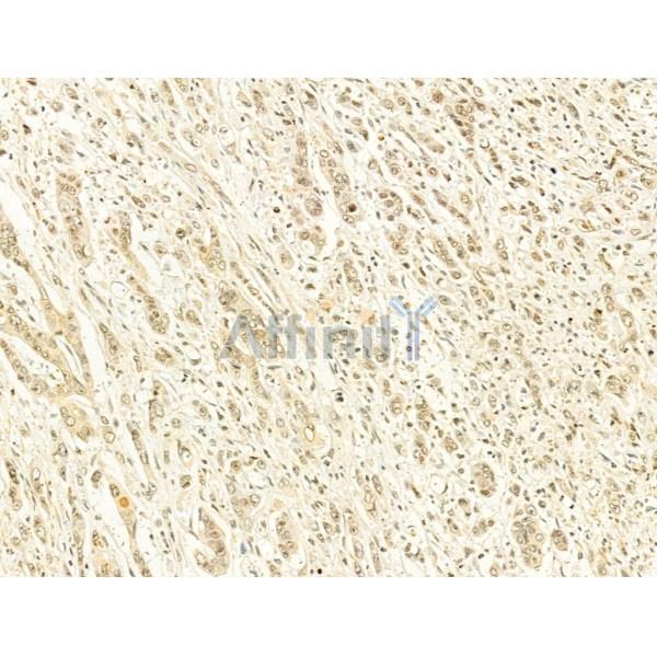 Phospho-mTOR (Ser2448) Antibody - AF3308 at 1/100 staining Human gastric cancer by IHC-P.