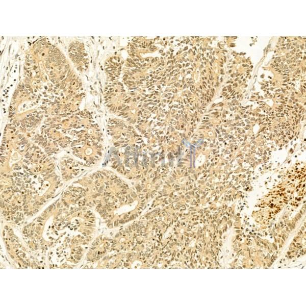 Phospho-mTOR (Ser2448) Antibody - AF3308 at 1/100 staining Human colorectal cancer by IHC-P.