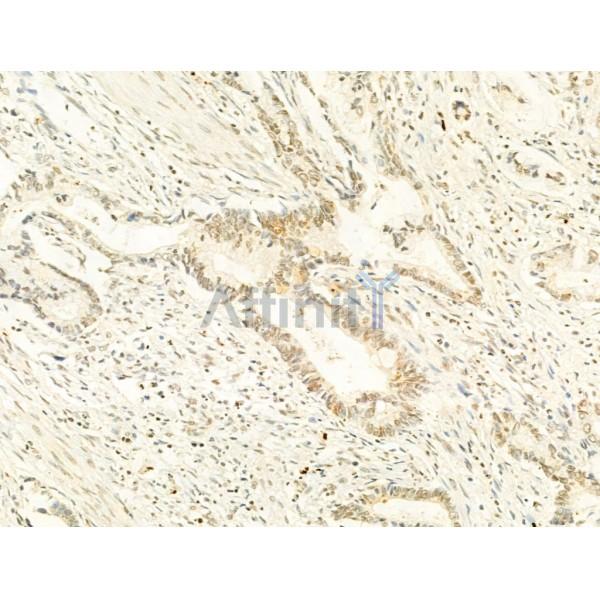 Phospho-mTOR (Ser2448) Antibody - AF3308 at 1/100 staining Human pancreatic cancer by IHC-P.