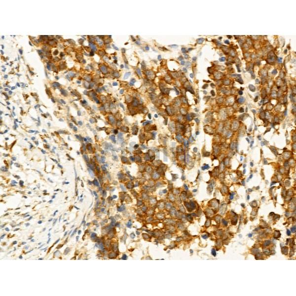 Phospho-JNK1/2/3 (Thr183+Tyr185) Antibody - AF3318 at 1/100 staining Human gastric cancer by IHC-P.