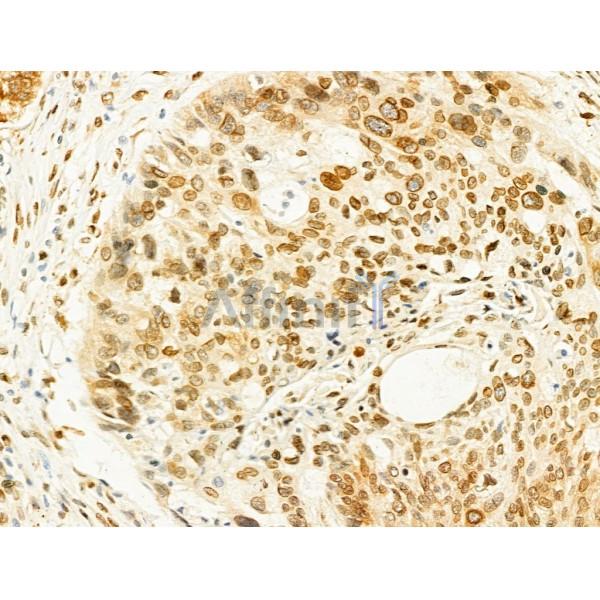 Phospho-JNK1/2/3 (Thr183+Tyr185) Antibody - AF3318 at 1/100 staining Human lung cancer by IHC-P.
